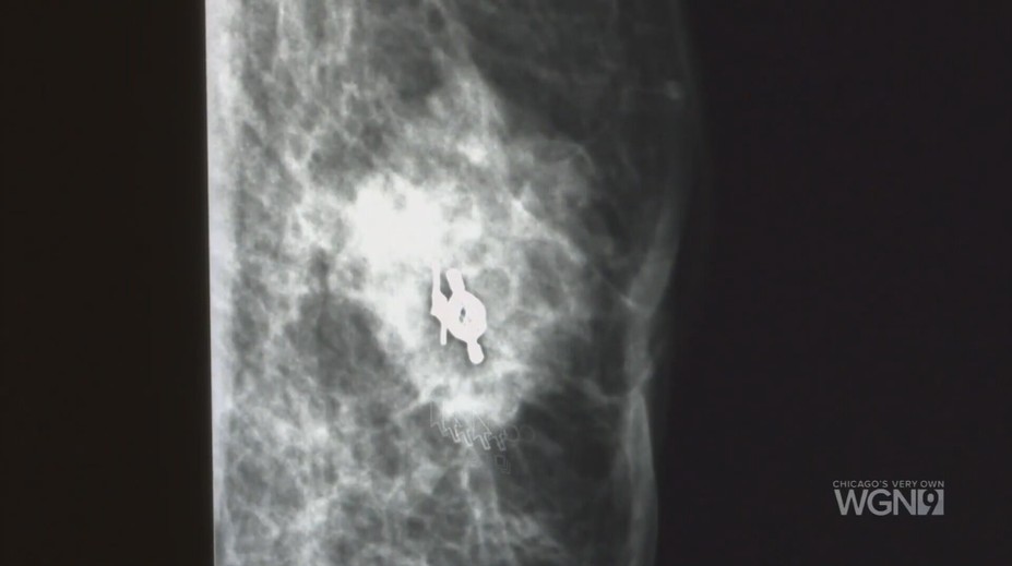 Nádor na prsníkoch neohrozuje len ženy. U mužov je ochorenie výrazne agresívnejšie