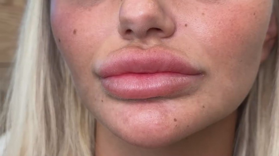 Uvažujete nad plastickou operáciou? Kyselina hyalurónová môže spôsobovať komplikácie