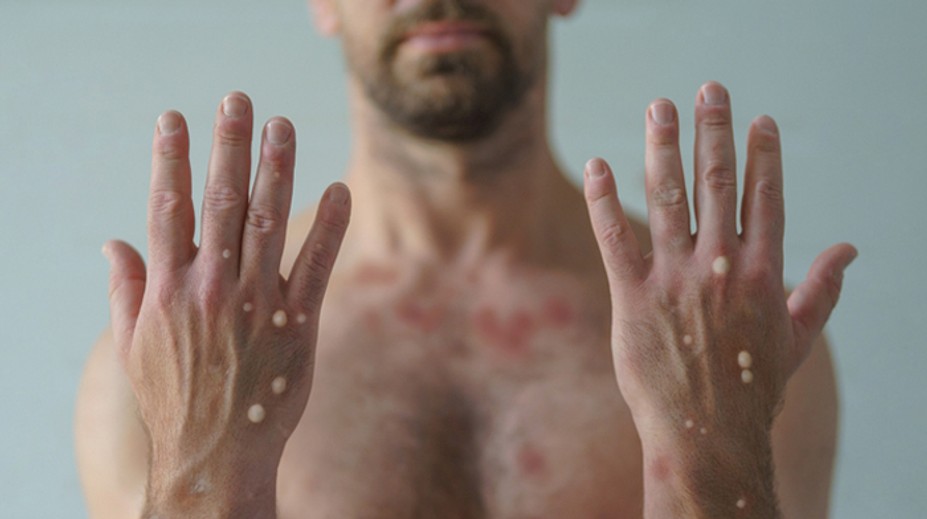 Opičie kiahne sa šíria aj u nás. Hygienici nevylučujú ďalšie prípady