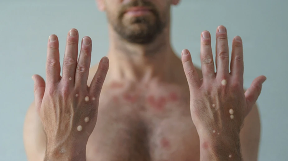 Opičie kiahne sa šíria aj u nás. Hygienici nevylučujú ďalšie prípady