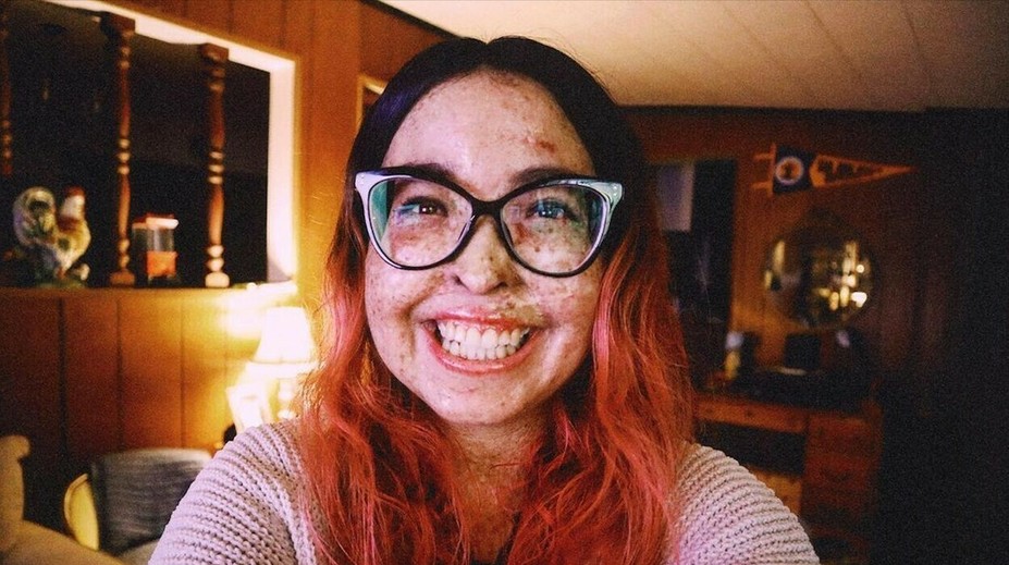 Andrea trpí vzácnou chorobou, ktorá ničí jej kožu. Lekári jej už 28-krát diagnostikovali rakovinu