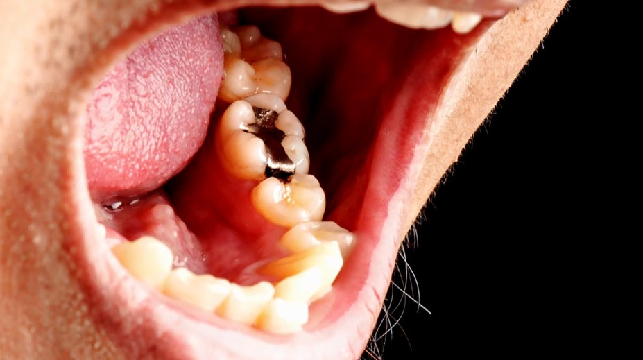 Amalgánové plomby končia, toto má byť náhrada. Zisťovali sme výhody a nevýhody