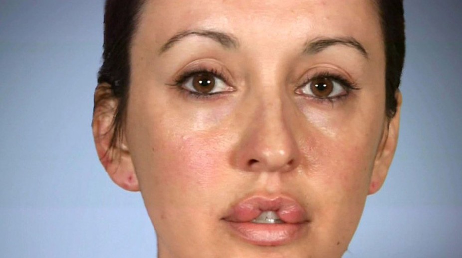 Desať rokov nezatvorila ústa. Chcela ich mať ako Angelina Jolie