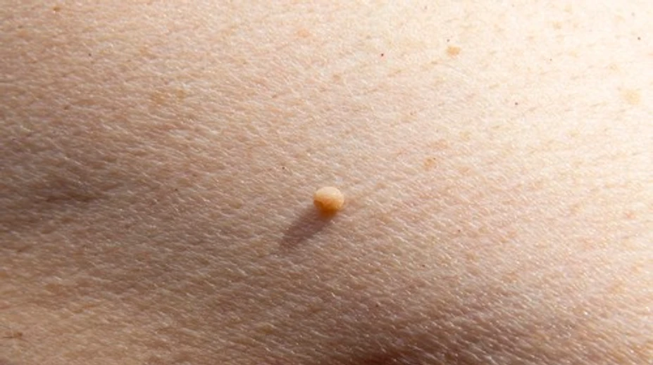 Malé kožné výrastky vyzerajú nevinne. Dermatologička varuje pred ich domácim odstraňovaním