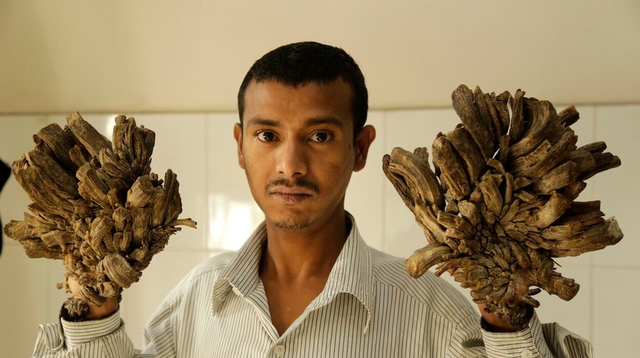 "Stromový muž" chce ukončiť svoje trápenie: Prosí lekárov o radikálne riešenie