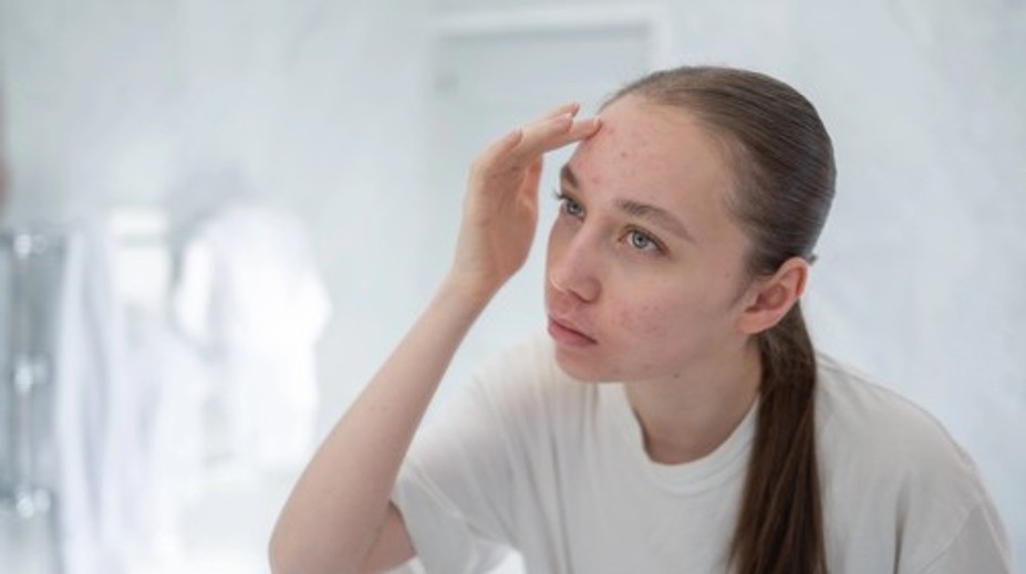 Akné nie je len pubertálny problém. Dermatologička radí, na čo si dať pozor