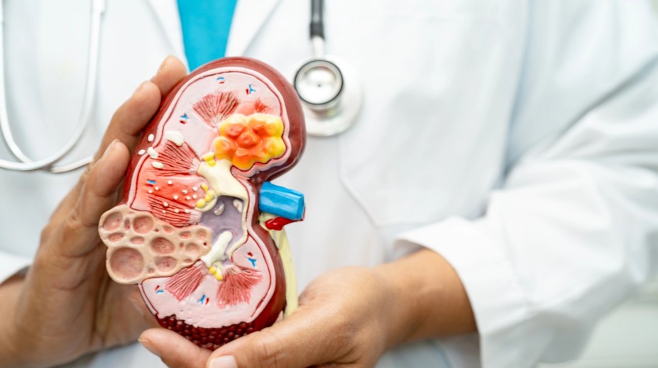 Zvláštny moč, opuchy, ale aj únava. Takto sa môžu hlásiť zlyhávajúce obličky, varujú lekári