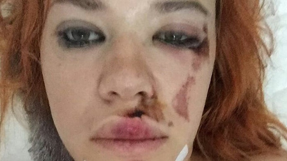 Speváčka zo skupiny Peter Bič Project mala nehodu! Zverejnila desivú fotku