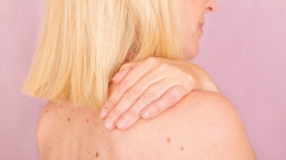 Rakovina, ktorú môžeme vidieť voľným okom. Ktoré kožné zmeny by ste nikdy nemali ignorovať?
