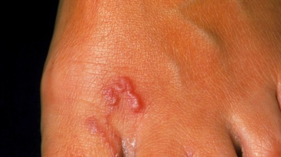 Pozor na nechcený suvenír z dovolenky. Strašidelného tropického parazita môžete chytiť na pláži