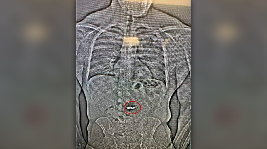 Muž mal ukradnúť luxusné náušnice za trištvrte milióna dolárov. Našli sa na röntgenovej snímke v jeho orgáne