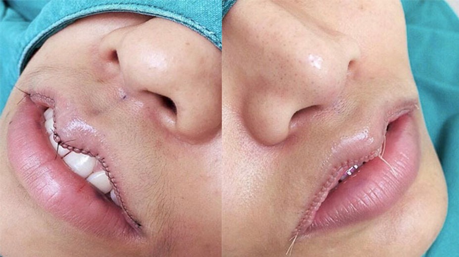 Ženy si drasticky nechávajú zmenšiť pery. Môže za to nový kozmetický trend