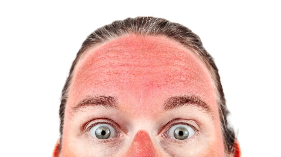 Pozor na zákerné slnko. Môže spôsobiť mnoho ťažkostí