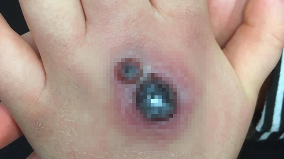 Dievčatku urobil pavúk dieru v ruke, takmer zomrelo