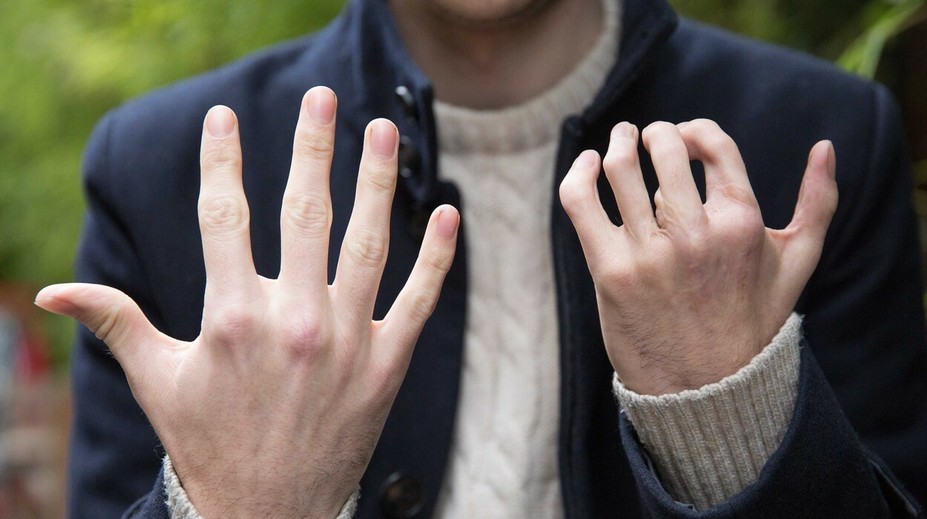 Herec nahradil chýbajúce prsty na rukách tými na nohe