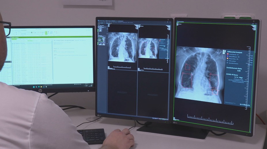 Odhalí aj to, čo by mohlo ľudskému oku ujsť. V Michalovciach pomáha s vyhodnotením röntgenov umelá inteligencia