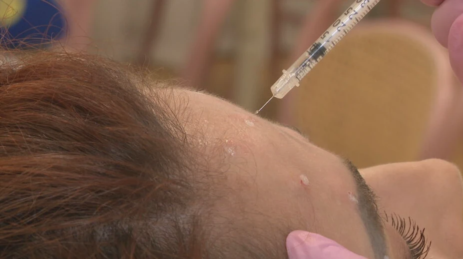 Botox a výplne mali dostať prísnejšie pravidlá. Zo zákona napokon vypadla dôležitá časť