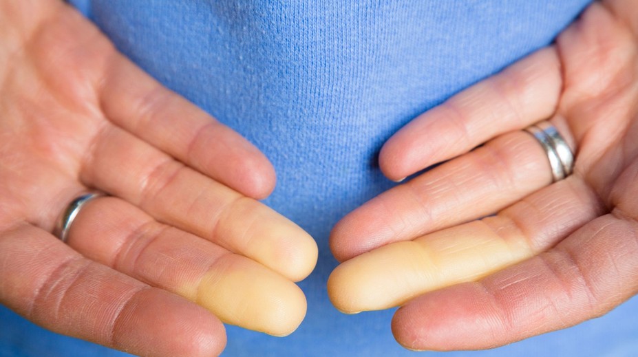 Menia vám ruky v zime farbu? Radšej to neignorujte