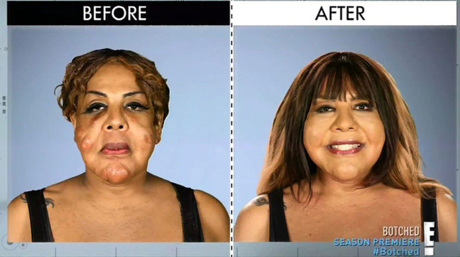 Falošný lekár ju zohavil. Do tváre jej voperoval cement