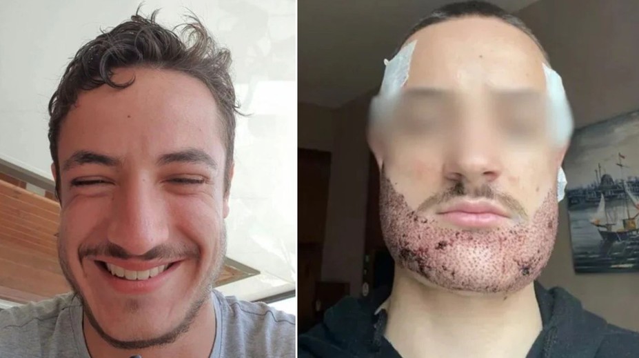 Študent si vzal život po tom, čo mu v Turecku transplantoval bradu realitný maklér vydávajúci sa za chirurga