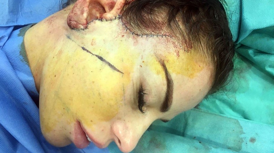 Len pre silné žalúdky! Modelka zverejnila zábery z kozmetického zákroku