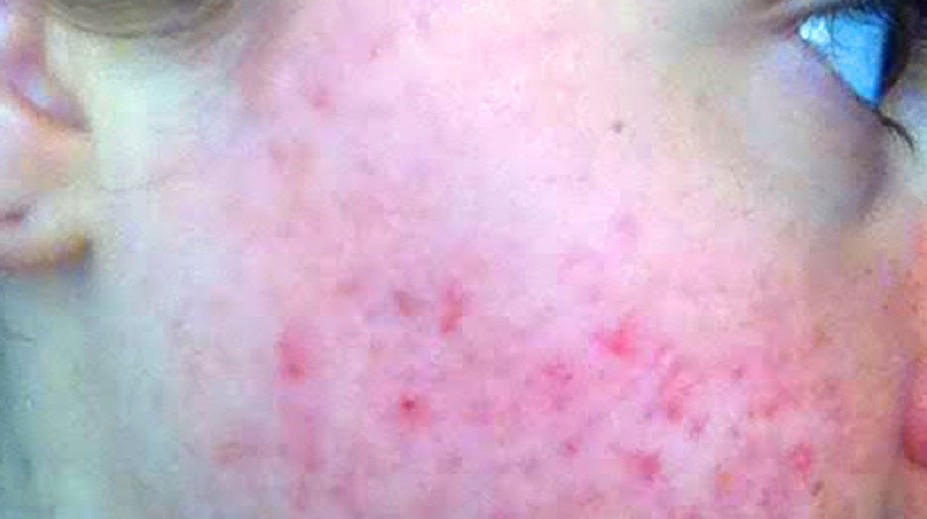 Dievča trápilo príšerné akné. Toto je výsledok jej experimentu so stravou