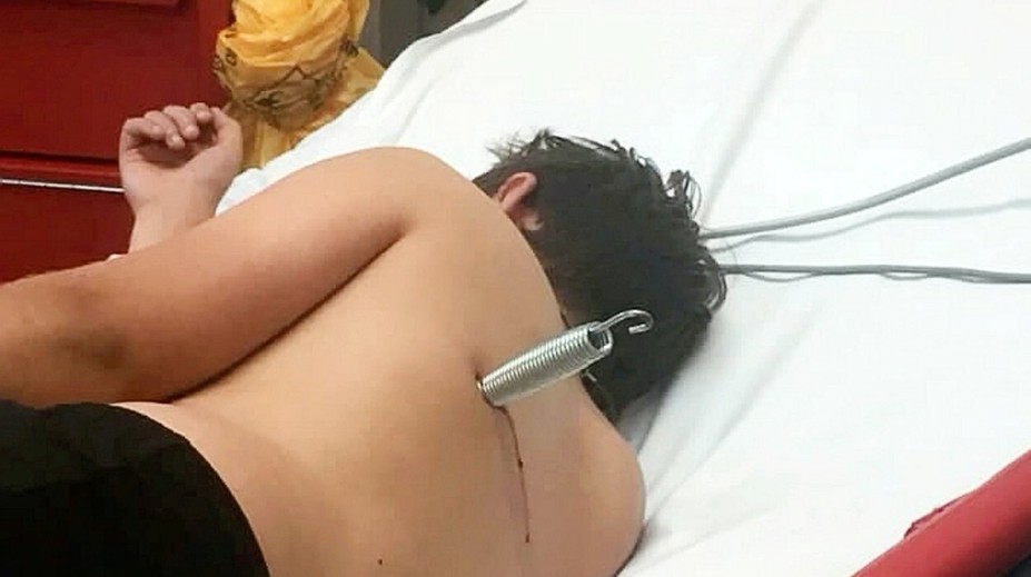 Nebezpečná trampolína: Chlapec pri skákaní skončil s pružinou zabodnutou v tele