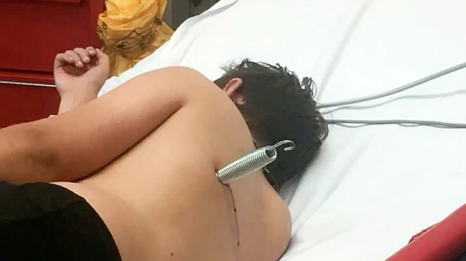 Nebezpečná trampolína: Chlapec pri skákaní skončil s pružinou zabodnutou v tele