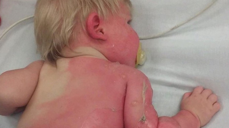 Srdcervúca fotografia: Matka chcela dieťa ovlažiť, namiesto toho ho obarila