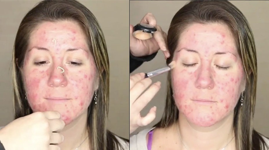 Šikovný zásah vizážistky. Žene zakryla akné bezchybným mejkapom