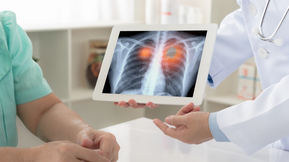 Zjazvené pľúca a problémy s dýchaním. Fibrózu často odhalia až príliš neskoro