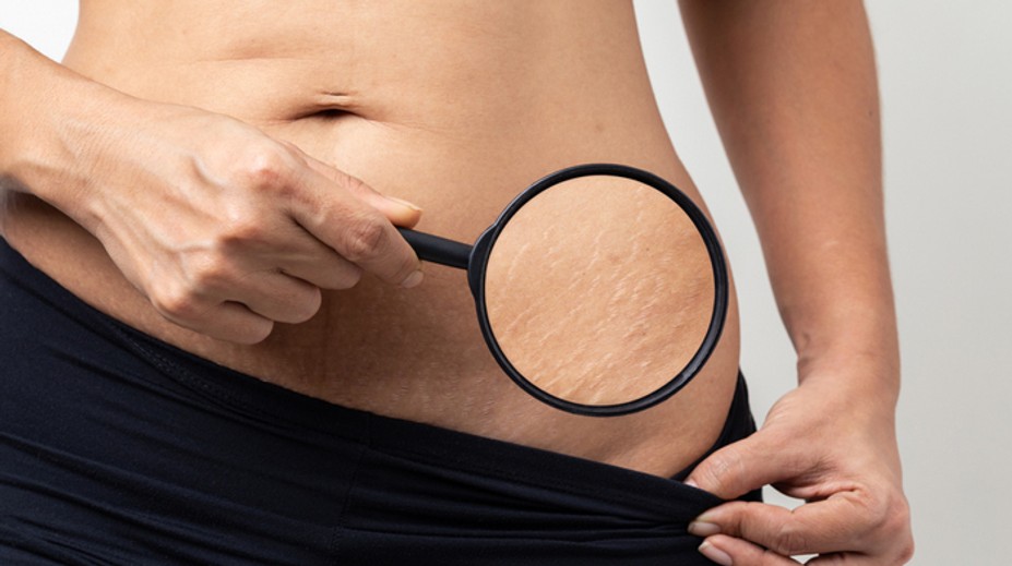 Trápia vás strie a vrásky? Teraz je správny čas na ich odstránenie