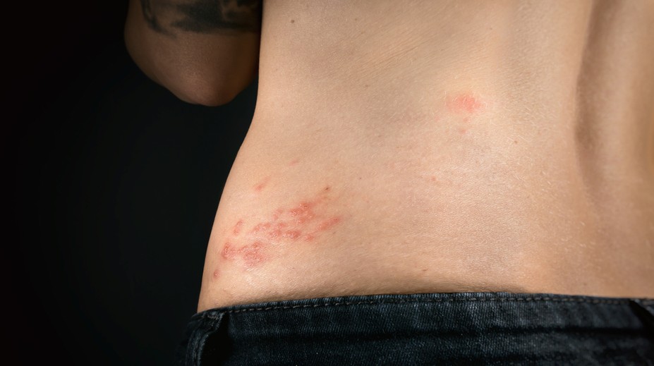 Nebezpečný pásový opar. Pre toto si naň dajte pozor a predchádzajte mu