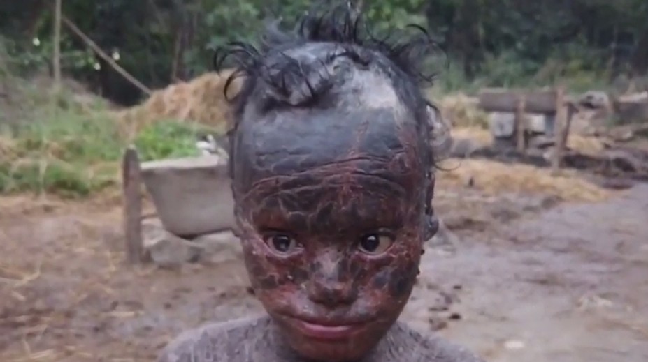 VIDEO: Chlapec (10) trpí vzácnou mutáciou. Jeho koža rýchlo schne a zhadzuje sa