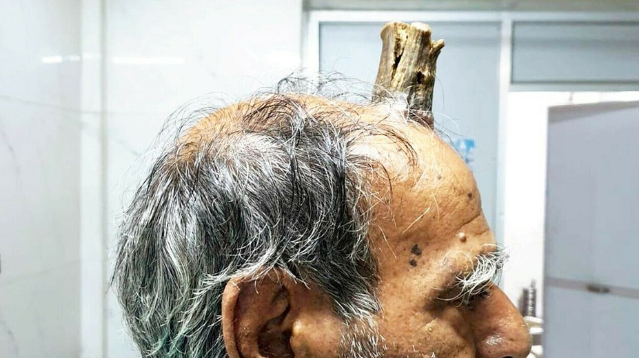 Vzácny prípad šokoval aj lekárov: Mužovi narástol na hlave "diabolský roh"