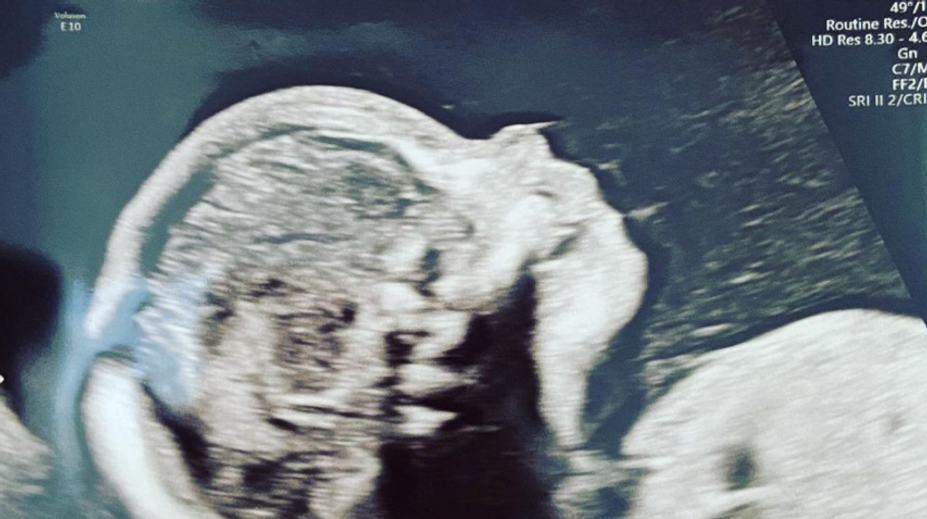 Druhé dieťa na ceste! Herečka prekvapila fotkou z ultrazvuku