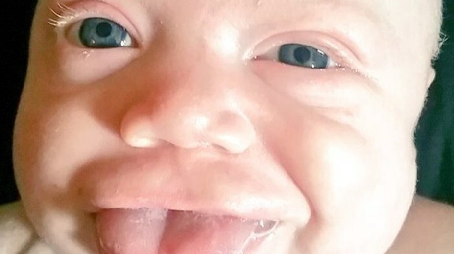 Dievčatku narástol veľký jazyk. Takto vyzerá teraz s úsmevom na perách