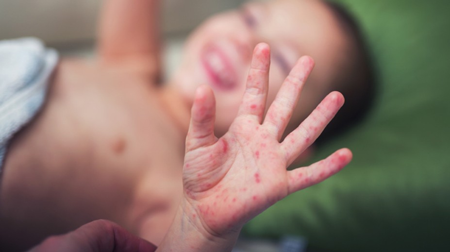 Lekári varujú: Covid má nový príznak, najmä u detí