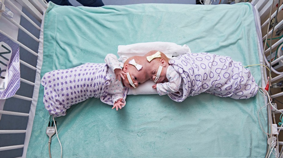 Vo Philadelphii oddelili desaťmesačné siamské dvojčatá. Spojené boli hlavami