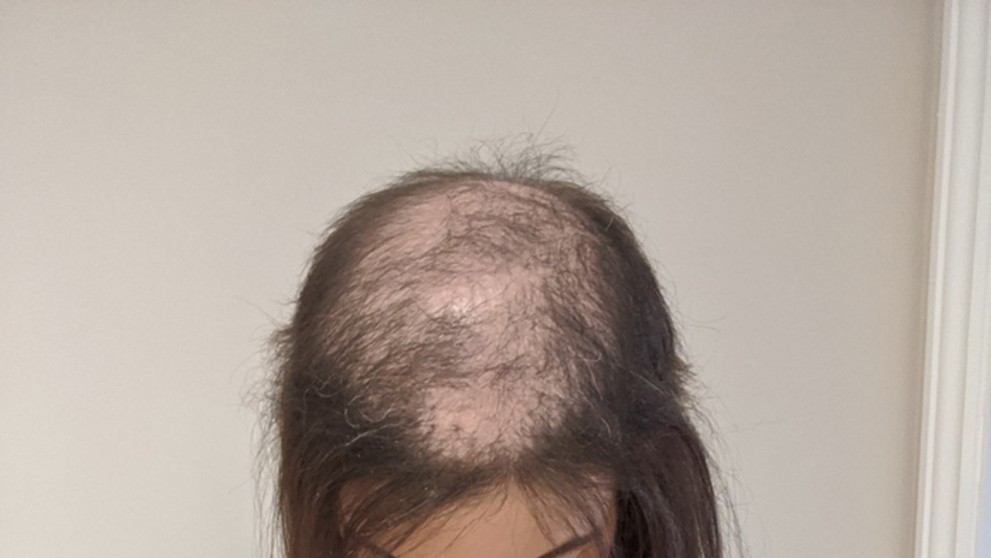 Hattie Gilford si vlasy trhala aj keď bola malé dievča.