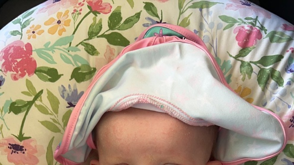  Armani Milbyová sa narodila so vzácnou genetickou poruchou.