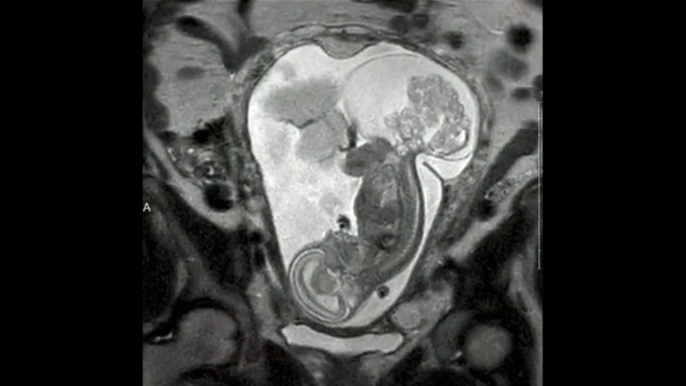 Dieťa a tumor