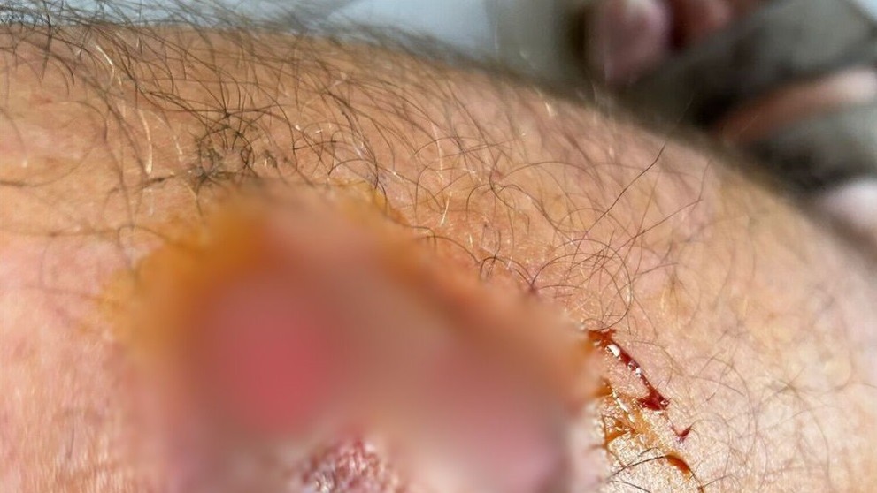 Miazga v spojení so slnkom spôsobila nepríjemné zranenia.