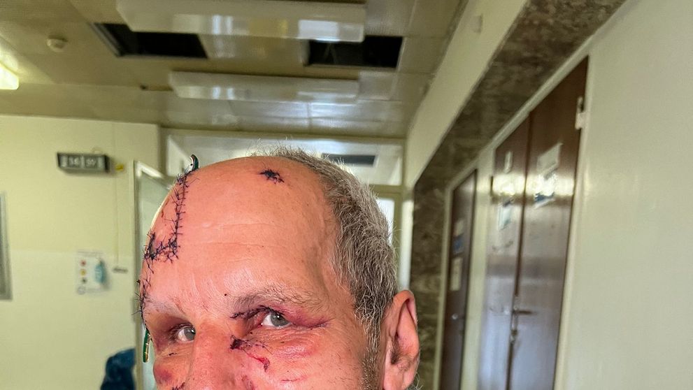 Napadnutý muž utrpel zranenia v oblasti hlavy a tváre