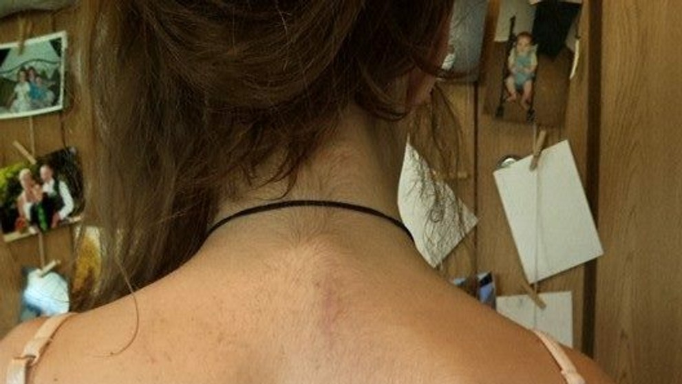 Sam Hansen a jej chrbtica teraz.