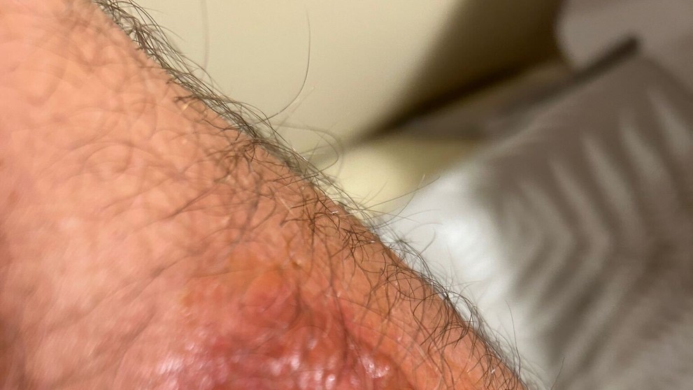 Miazga v spojení so slnkom spôsobila nepríjemné zranenia.