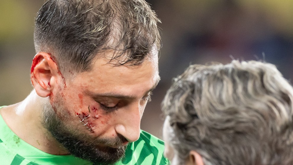 Gianluigi Donnarumma utrpel krvavé zranenie tváre.