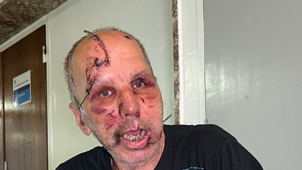 Zranenia utrpel v oblasti tváre - pera, čelo a temeno hlavy.