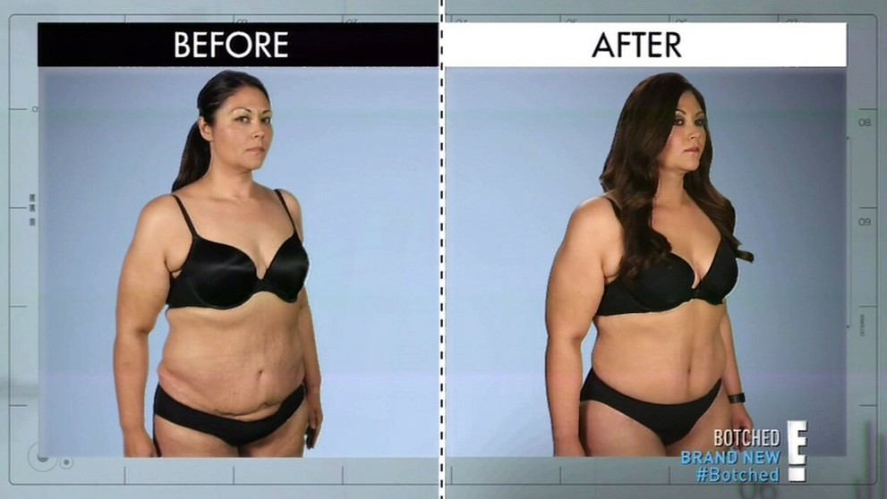 Samantha Taylor pred a po operácii.