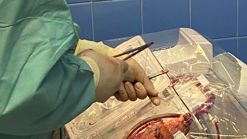 Transplantácia bijúceho srdca. 